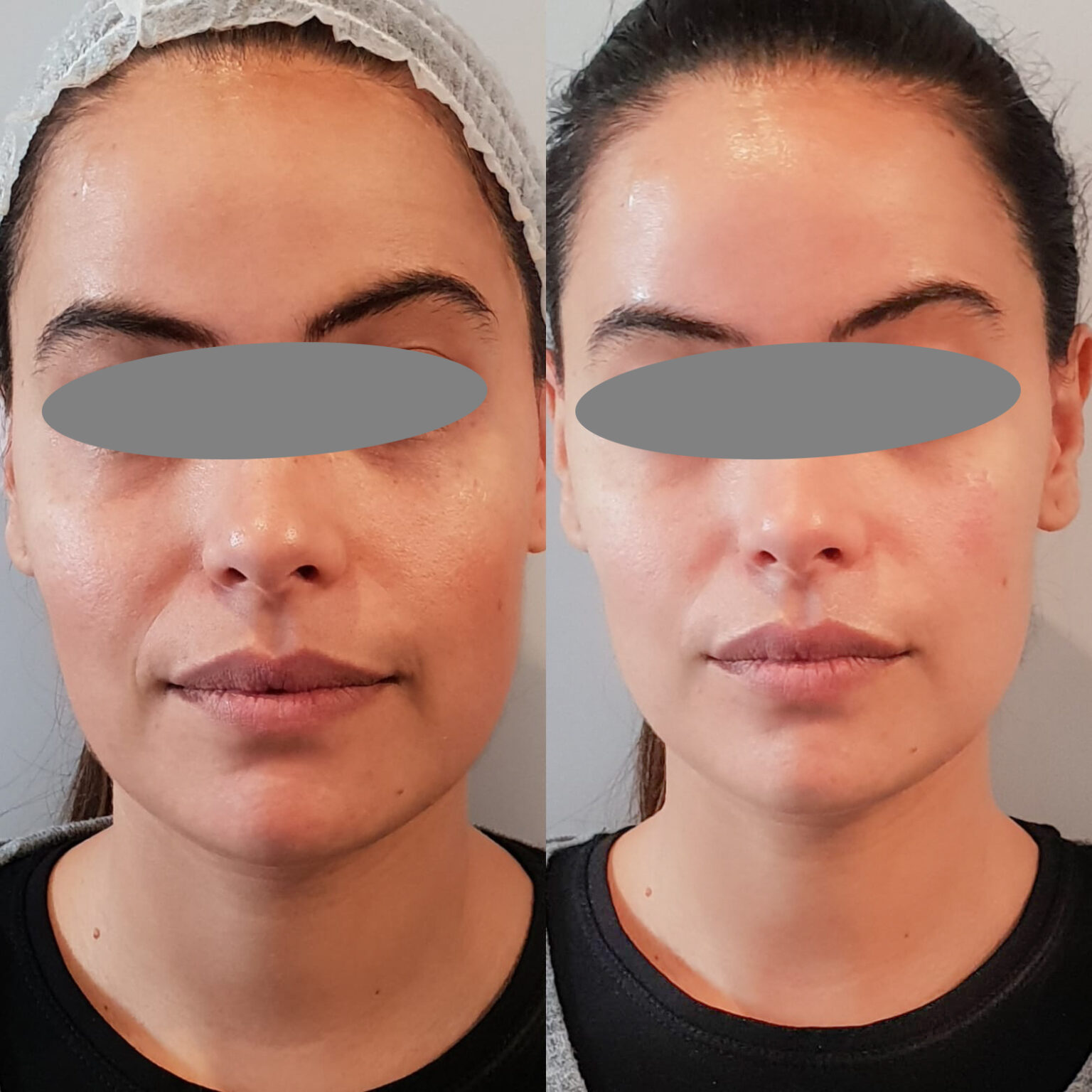 Карбоновый пилинг для лица эффект фото до и после